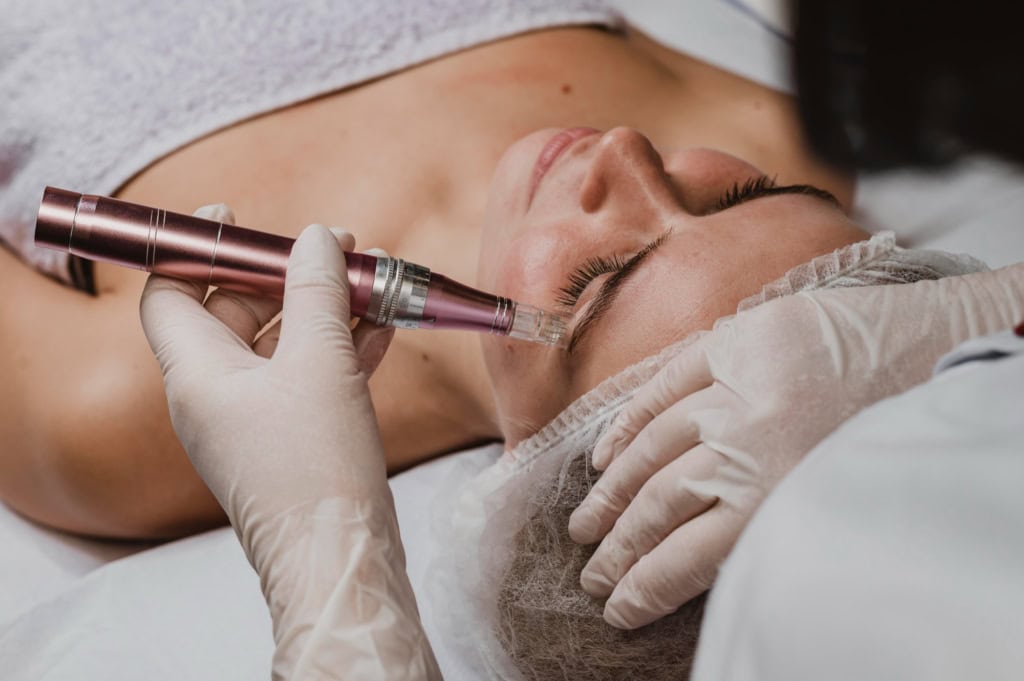 Skin Needling